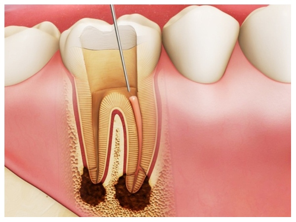 Viêm tủy răng do sâu răng không được điều trị kịp thời