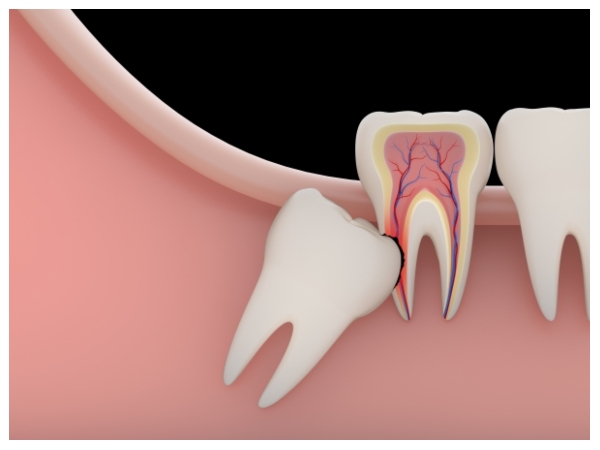 Răng khôn mọc lệch hoặc ngầm gây đau nhức và ảnh hưởng đến khả năng ăn nhai