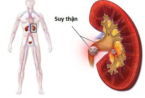 Bệnh sẽ được phân thành hai loại chính: suy thận mạn tính và suy thận cấp tính