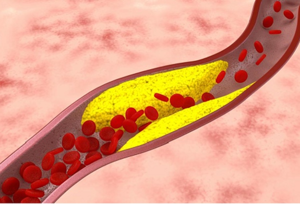 Xơ vữa động mạch khiến mạch máu hẹp dần, giảm độ linh hoạt