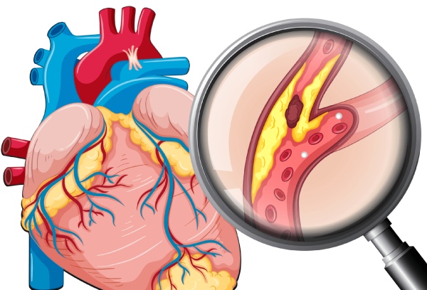 Nhiều yếu tố làm tăng nguy cơ xơ vữa động mạch