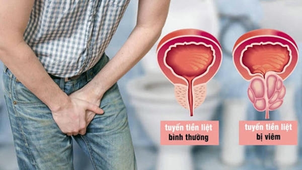 Viêm tuyến tiền liệt là bệnh lý thường gặp ở nam trung niên và cao tuổi