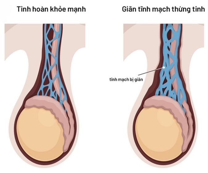 Giãn mạch thừng tinh hiện tượng tĩnh mạch sinh tinh và thừng tinh bị giãn quá mức