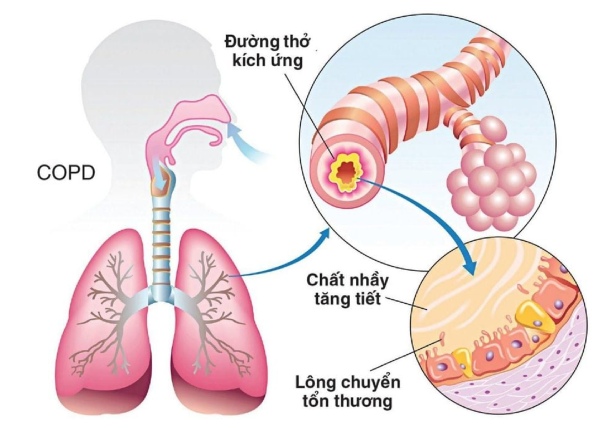 Bệnh phổi tắc nghẽn mạn tính thường khởi phát với những triệu chứng mờ nhạt