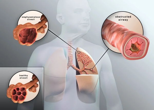 Bệnh nhân COPD có tuổi thọ giảm, đặc biệt khi bệnh tiến triển nặng