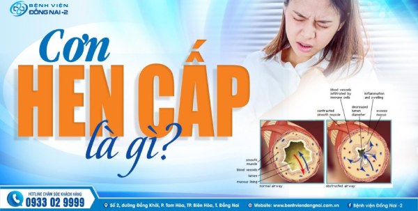 Hen cấp là một tình trạng bệnh lý đường hô hấp phổ biến