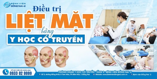 Liệt mặt ngoại biên là bệnh lý thần kinh phổ biến