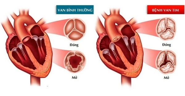 Bệnh van tim là gì?