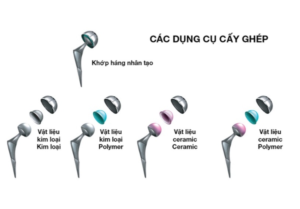 Khớp háng nhân tạo làm từ titanium và nhựa cao cấp, tương thích sinh học cao