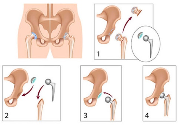 Thay khớp háng nhân tạo có hai loại: toàn phần và bán phần