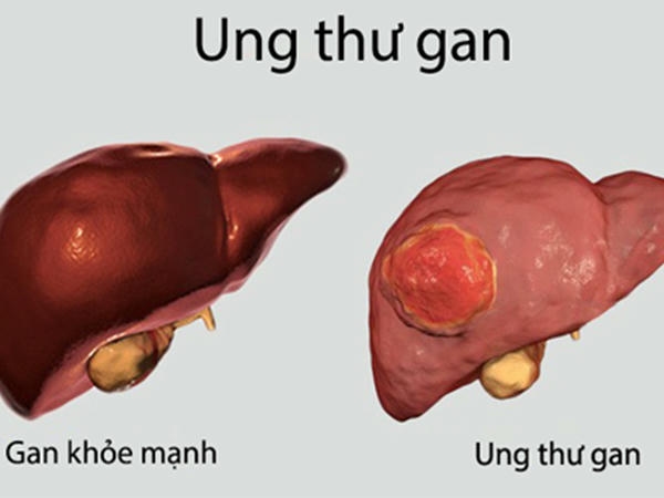 Ung thư gan xảy ra khi các tế bào ung thư phát triển trong gan