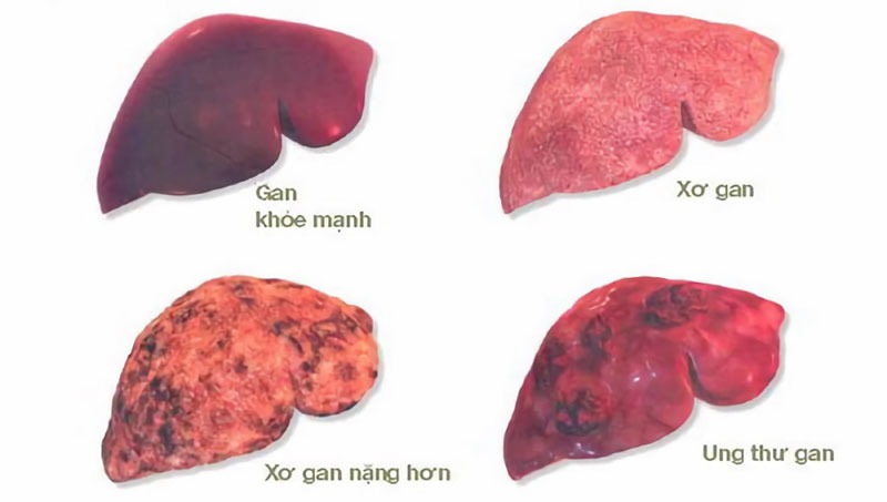 Khi xơ gan biểu hiện nặng sẽ có các triệu chứng rõ ràng