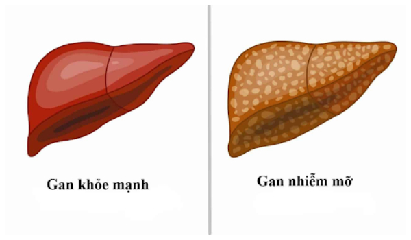 Gan nhiễm mỡ là tình trạng mô gan tích tụ quá nhiều chất béo