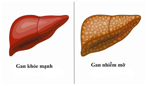 Gan nhiễm mỡ là tình trạng mỡ tích tụ trong gan vượt quá 5% trọng lượng gan