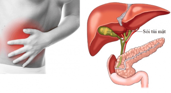 Sỏi túi mật là các tinh thể rắn hình thành từ cholesterol hoặc bilirubin trong túi mật