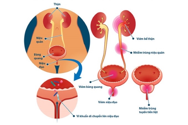 Nhiễm trùng đường tiết niệu gây ra nhiều cảm giác không thoải mái và đau đớn