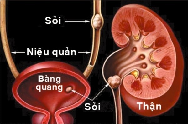 Sỏi niệu gây khó chịu, cản trở trong đời sống sinh hoạt