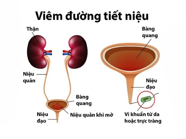 Viêm tiết niệu là vấn đề y tế phổ biến mà nhiều phụ nữ và đàn ông gặp phải