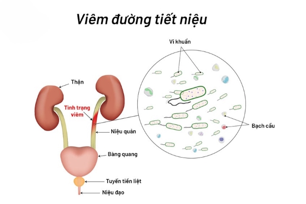 95% nguyên nhân gây viêm đường tiết niệu là do nhiễm khuẩn