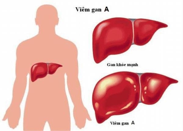 Virus rất dễ lây lan, đặc biệt gồm người chưa tiêm phòng, trẻ em 5-14 tuổi