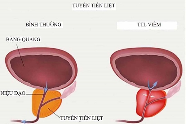 Viêm tuyến tiền liệt là một bệnh lý phổ biến ở nam giới