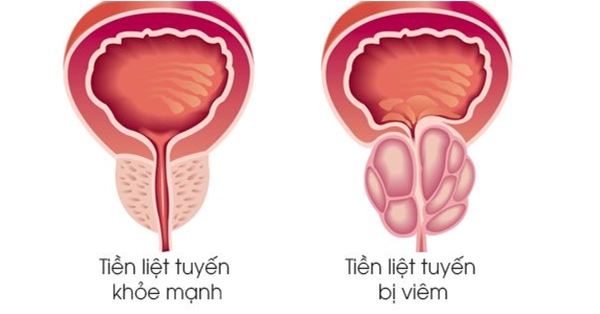 Viêm tuyến tiền liệt là một trong những nguyên nhân gây xuất tinh máu