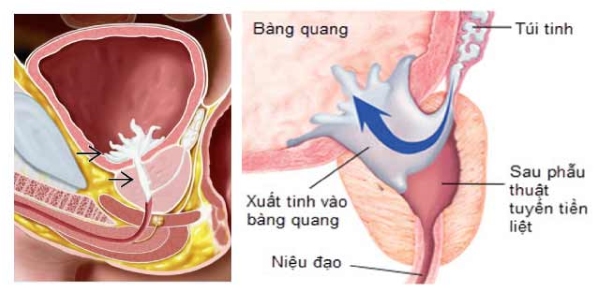 Xuất tinh ngược dòng​