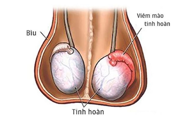 Virus quai bị gây viêm tinh hoàn