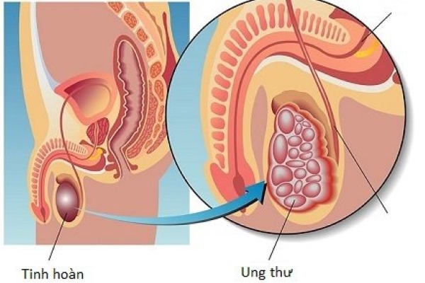 Ung thư tinh hoàn hiếm gặp nhưng vẫn có khả năng xảy ra