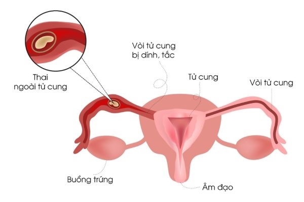 Đau bụng dữ dội và chảy máu âm đạo bất thường có thể là triệu chứng của mang thai ngoài tử cung
