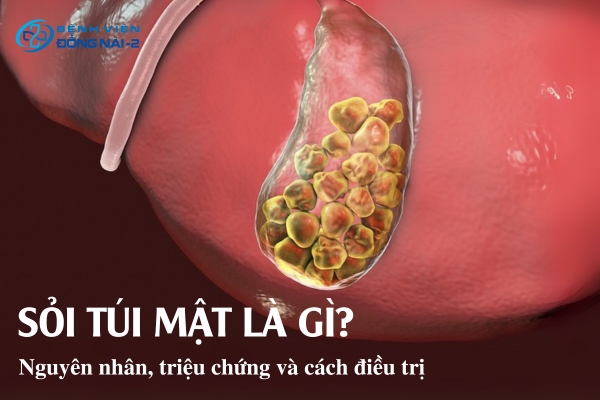 Sỏi túi mật là gì