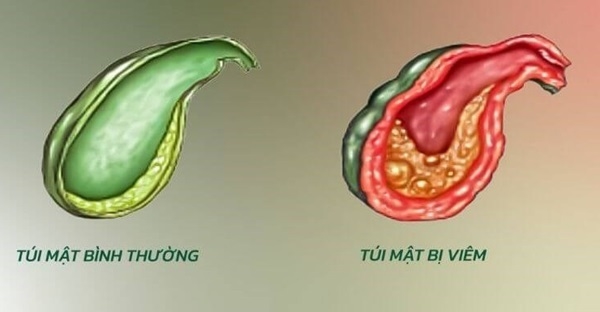 Các biến chứng của sỏi túi mật là gì và mức độ ảnh hưởng