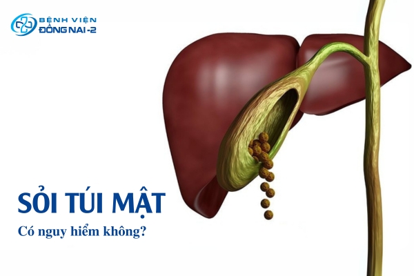 Sỏi túi mật có nguy hiểm không?