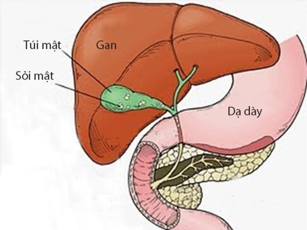Vị trí của sỏi túi mật 