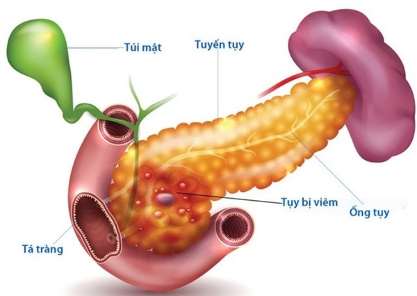 Vùng tụy bị viêm