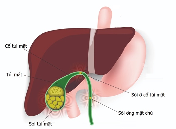 Sỏi túi mật là gì?