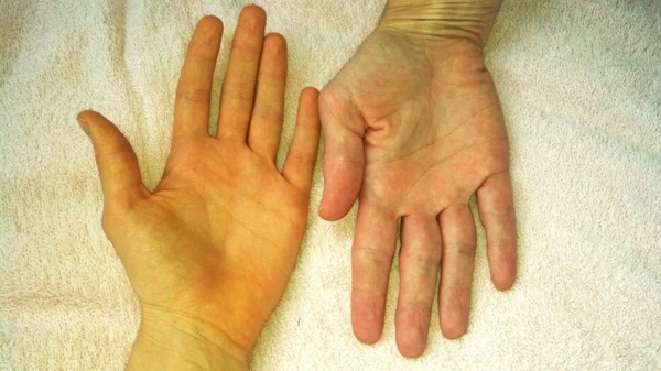 Vàng da - Triệu chứng dễ nhận biết của viêm gan A 