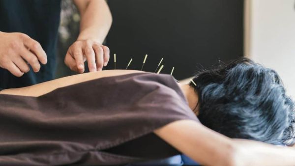 Châm cứu chữa đau vai gáy mang lại nhiều hiệu quả