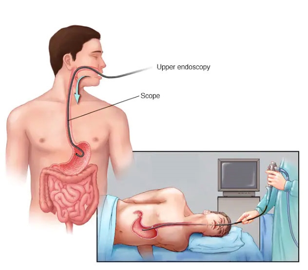 Nội soi dạ dày là phương pháp dùng ống mềm có camera để kiểm tra bên trong dạ dày
