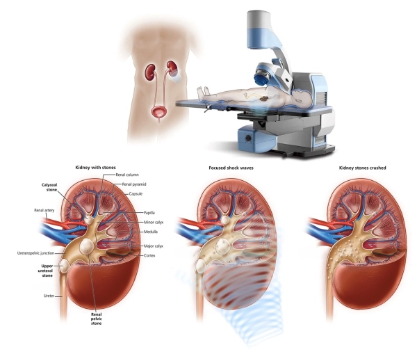 Tán sỏi ngoài cơ thể trên máy tán sỏi thận thế hệ mới