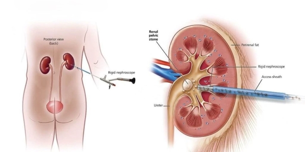 Tán sỏi bằng nội soi qua da
