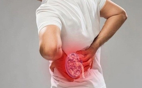 Sỏi thận vẫn có thể tái phát nếu người bệnh không giữ chế độ ăn uống và sinh hoạt lành mạnh