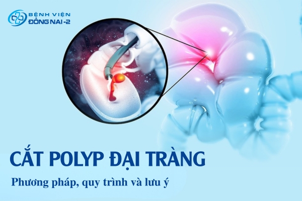 Cắt Polyp đại tràng cần chuẩn bị và lưu ý những gì?
