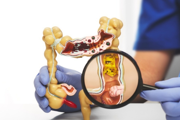 Bắt buộc cắt polyp đại tràng nếu bệnh tiến triển nặng