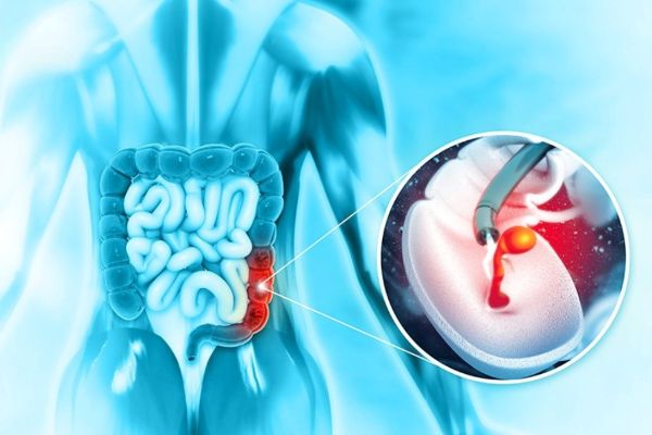 Tìm hiểu chi tiết về cắt polyp đại tràng