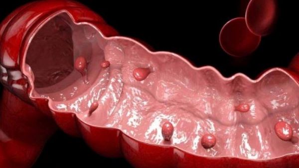 Thông tin chi tiết về cắt polyp trực tràng