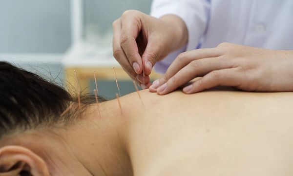 Xem xét một số huyệt châm cứu đau vai gáy