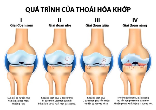Quá trình hình thành thoái hoá khớp gối