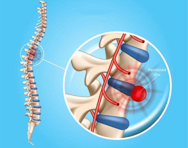Mổ thoát vị đĩa đệm​ trong trường hợp nặng
