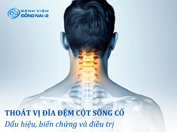 Tìm hiểu các dấu hiệu, biến chứng thoát vị đĩa đệm cột sống cổ